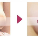 乳头乳晕整形,乳头乳晕整形术的全面解析